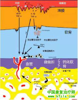 骨关节炎的治疗