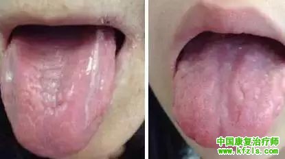 舌苔辨识9种中医体质