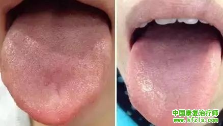 舌苔辨识9种中医体质