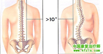 脊柱侧弯