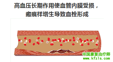 高血压是这样一步一步毁掉一个人的