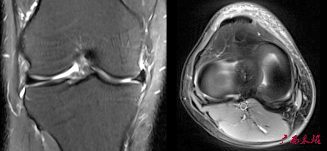 半月板损伤MRI诊断