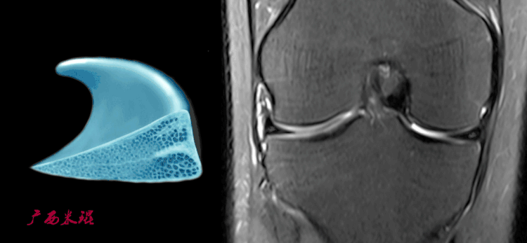 半月板损伤MRI诊断