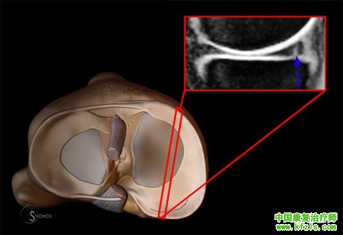 半月板损伤MRI诊断