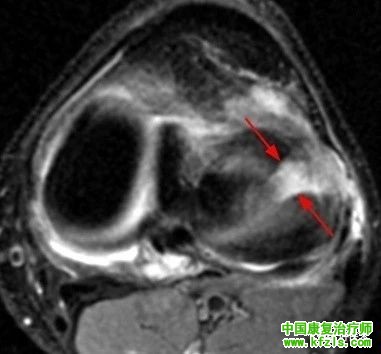 半月板损伤MRI诊断
