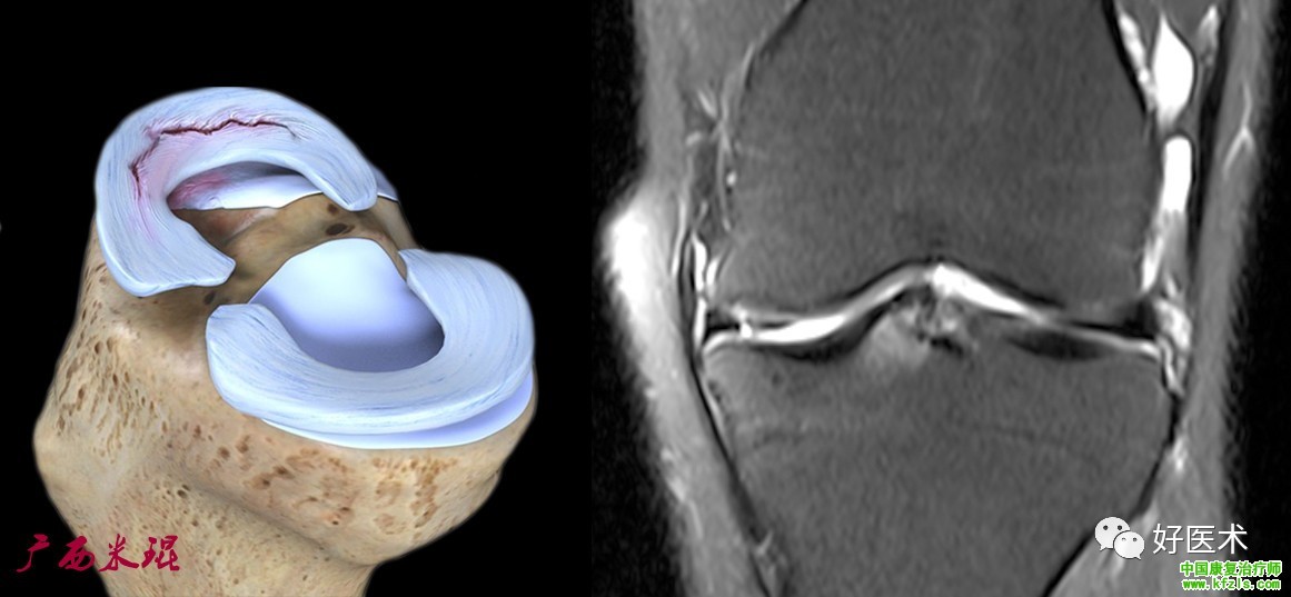 半月板损伤MRI诊断