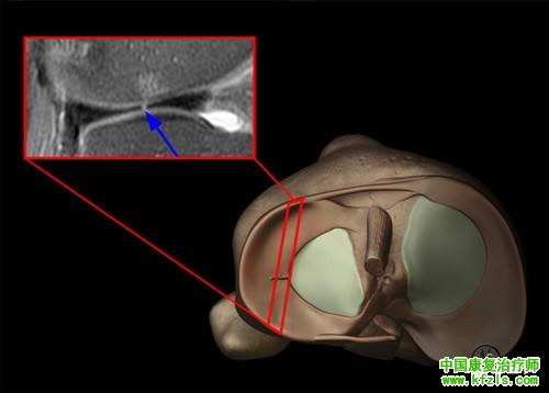 半月板损伤MRI诊断