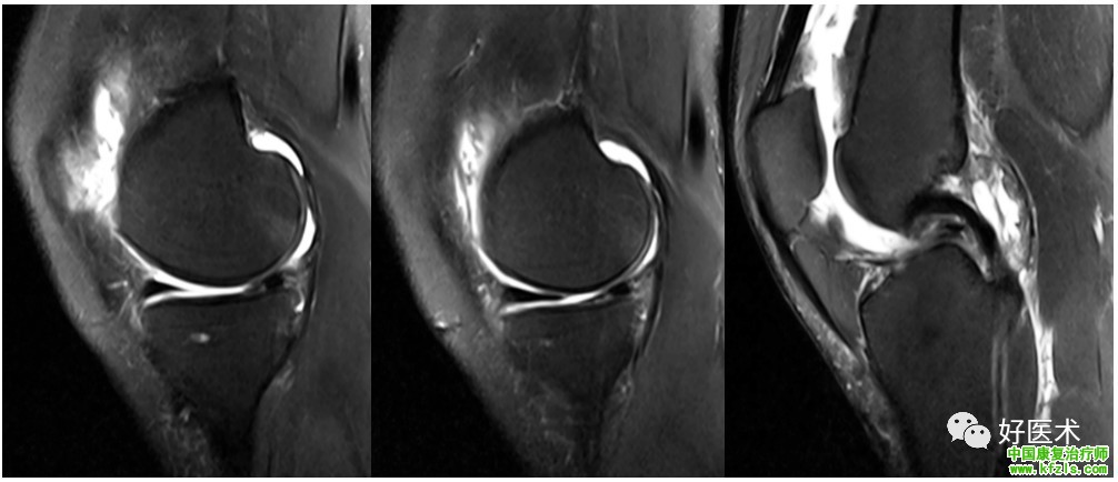 半月板损伤MRI诊断
