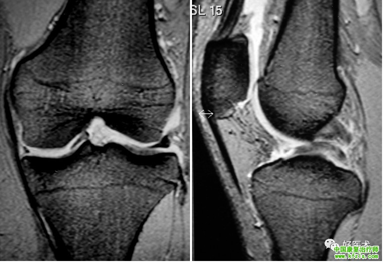 半月板损伤MRI诊断