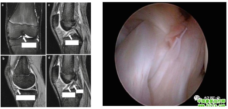 半月板损伤MRI诊断
