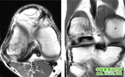 半月板损伤MRI诊断