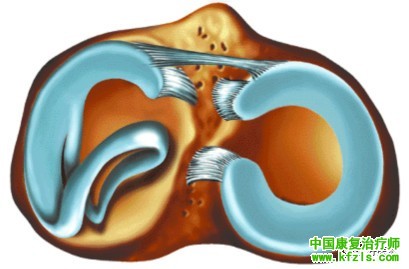 半月板损伤MRI诊断