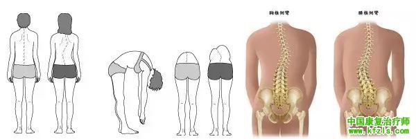 脊椎侧弯常见的类型评估与康复治疗