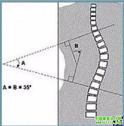 脊椎侧弯常见的类型评估与康复治疗
