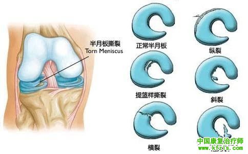 半月板损伤是保守治疗还是手术？