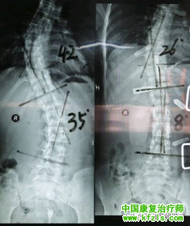 青少年特发性脊柱侧弯的发病机制与支具治疗