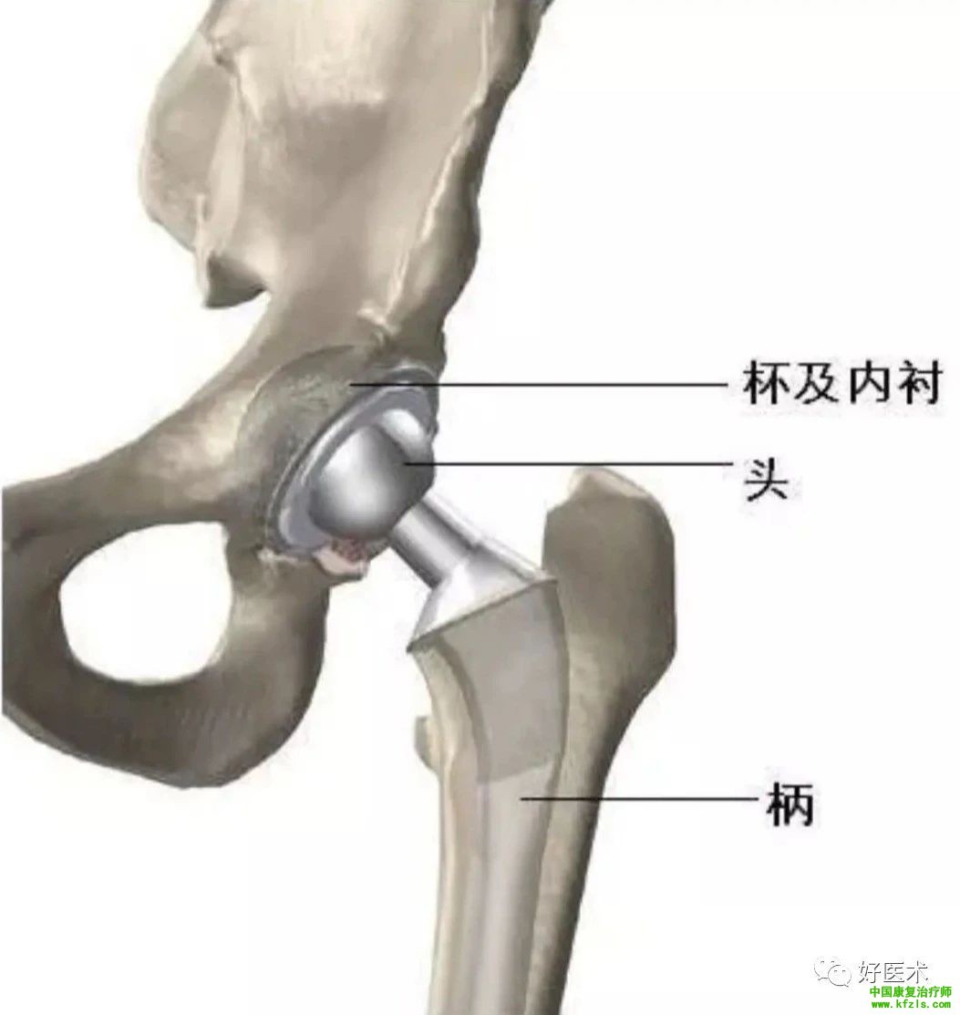 关节置换术后康复