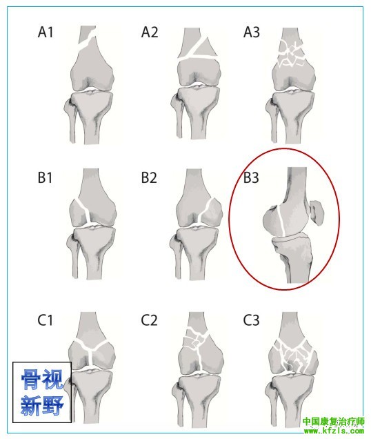 全面讲解Hoffa骨折