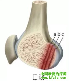 全面讲解Hoffa骨折