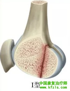 全面讲解Hoffa骨折