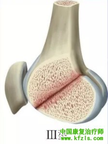 全面讲解Hoffa骨折