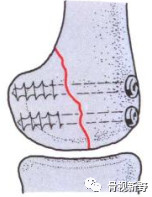 全面讲解Hoffa骨折