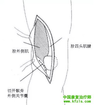 全面讲解Hoffa骨折