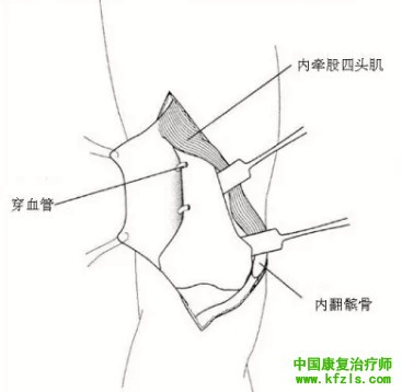 全面讲解Hoffa骨折