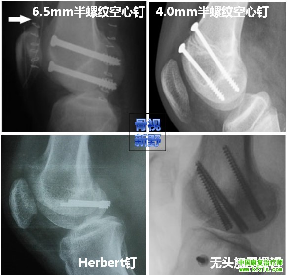 全面讲解Hoffa骨折