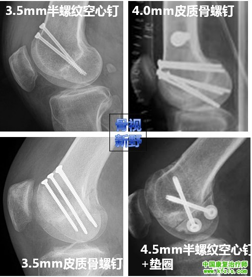 全面讲解Hoffa骨折