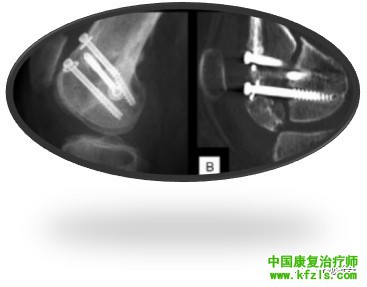 全面讲解Hoffa骨折