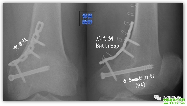 全面讲解Hoffa骨折