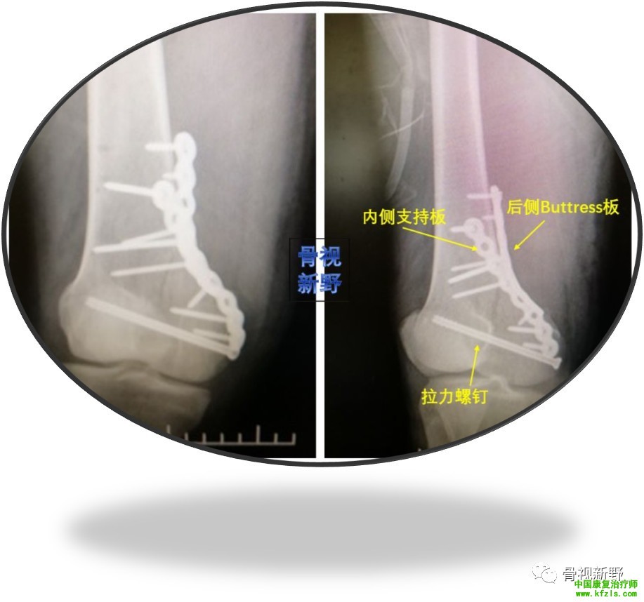 全面讲解Hoffa骨折