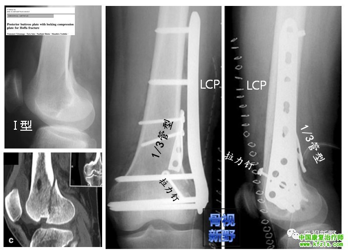 全面讲解Hoffa骨折