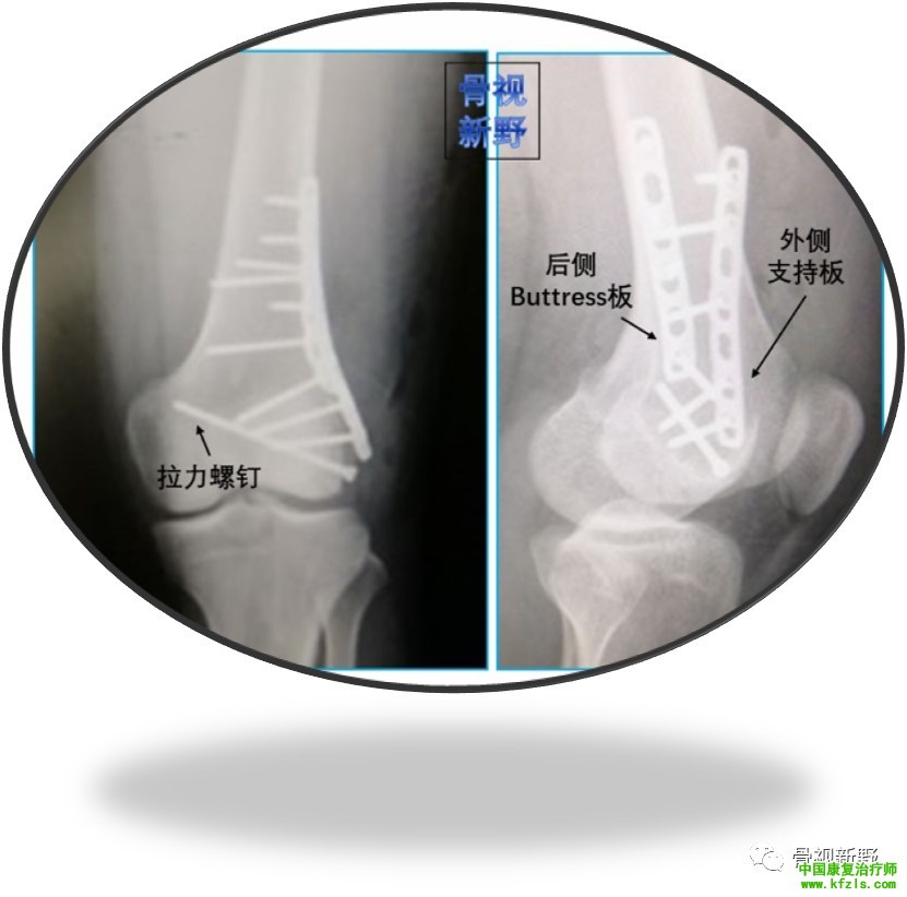 全面讲解Hoffa骨折