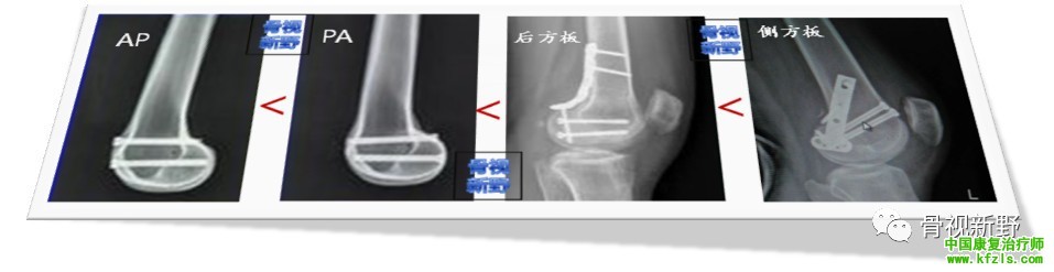 全面讲解Hoffa骨折