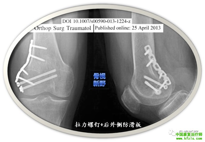 全面讲解Hoffa骨折