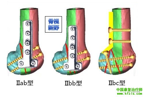 全面讲解Hoffa骨折