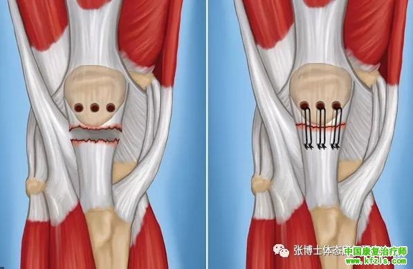 髌韧带损伤的机制与康复训练方法