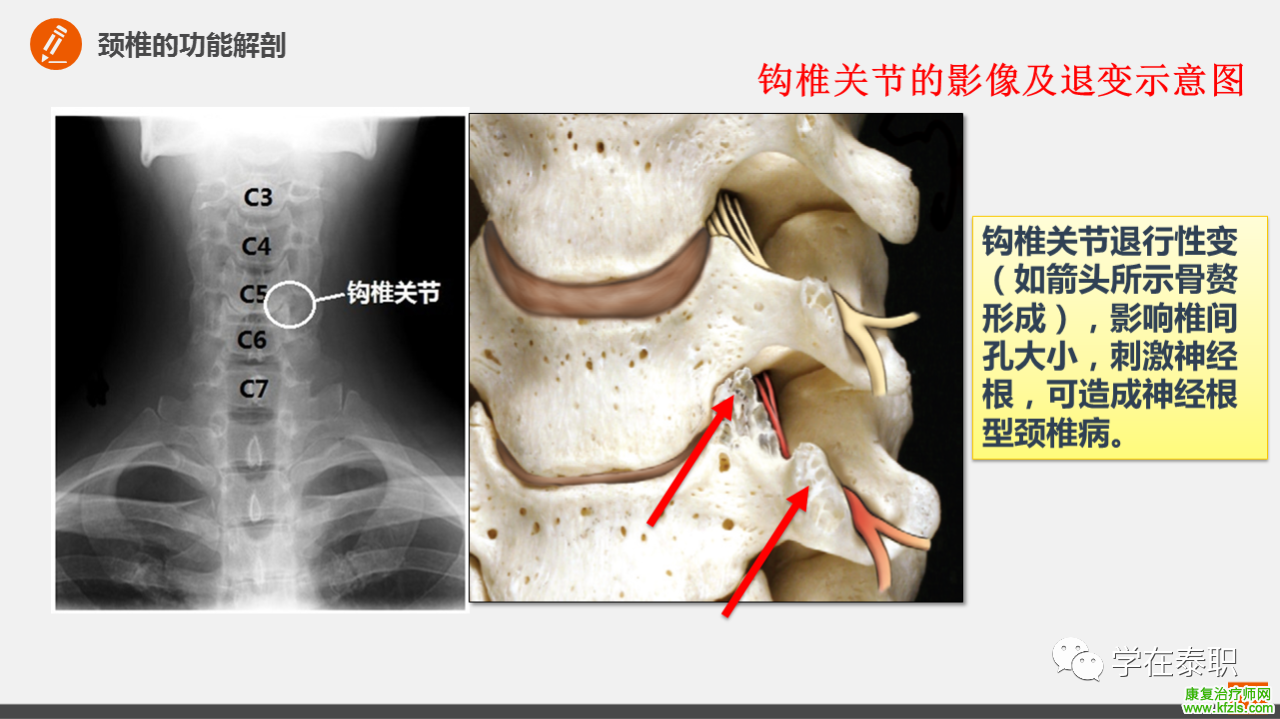 颈椎病的临床康复