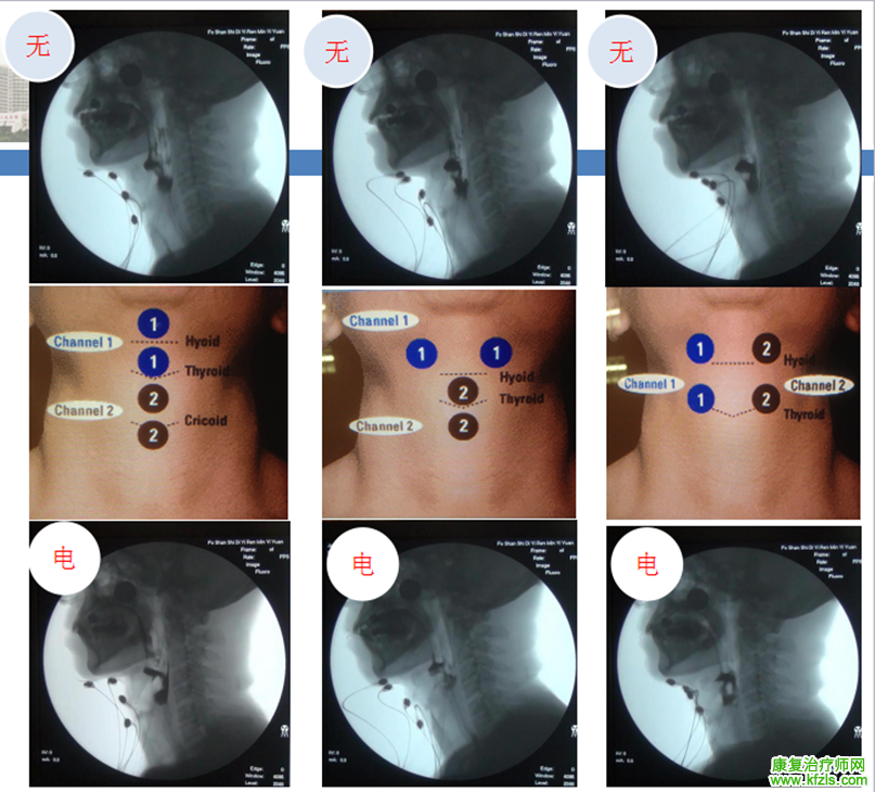 吞咽障碍电刺激的选择