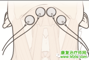 吞咽障碍电刺激的选择