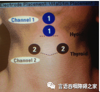 吞咽障碍电刺激的选择