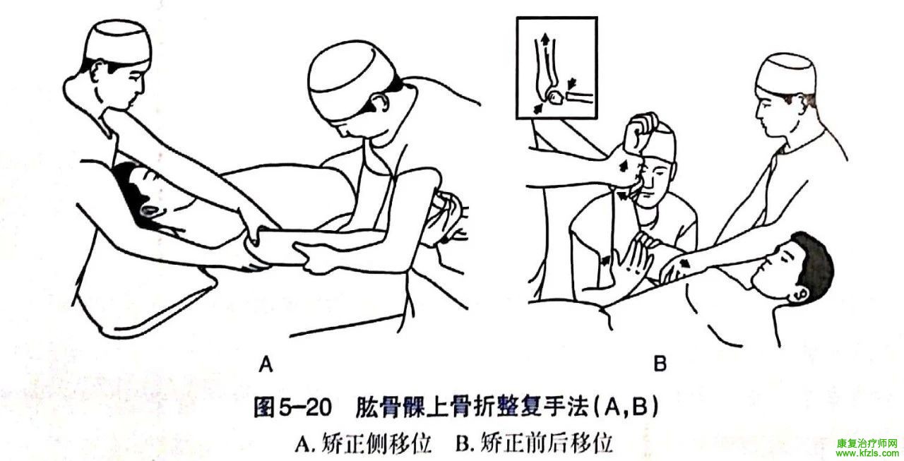 各部位骨折的完美手法复位