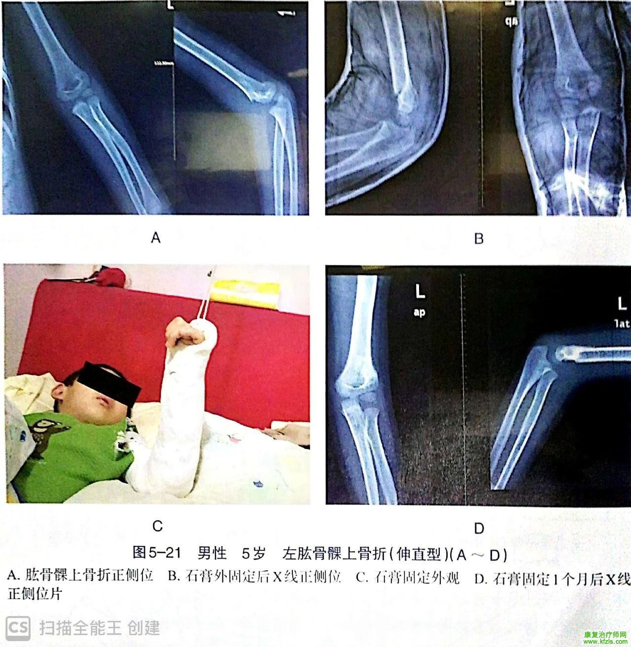 各部位骨折的完美手法复位