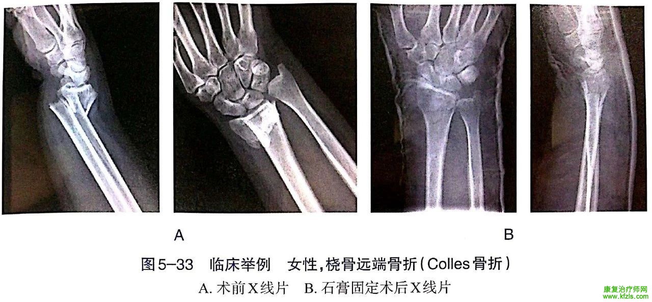 各部位骨折的完美手法复位