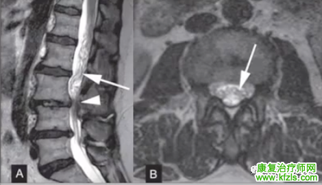 腰椎MRI