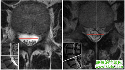 腰椎MRI