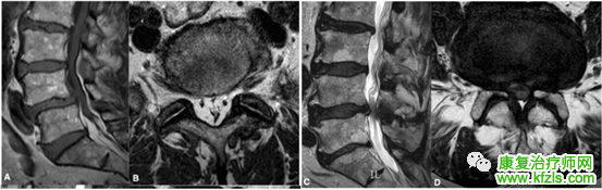 腰椎MRI