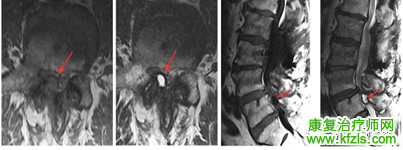 腰椎MRI